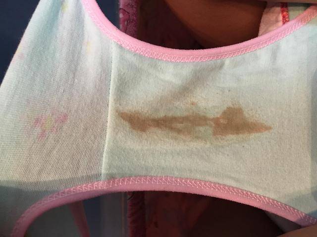 女子长期月经不调查出子宫内膜癌